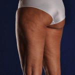 Preop Liposculpture of Thighs and Knees