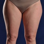 Preop Liposuction