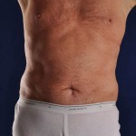 Postop Liposuction of the upper and lower Abdomen, Hips and Flanks