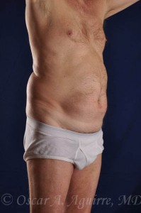 Preop Liposuction of the upper and lower Abdomen, Hips and Flanks