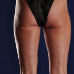 SmartLipo Liposculpture of bilateral inner and outer thighs